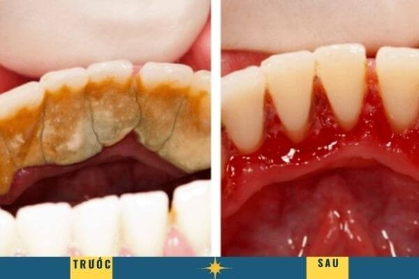 Sau khi lấy cao răng, các mẹ cũng cần lưu ý và duy trì chế độ chăm sóc răng miệng đầy đủ, đúng cách